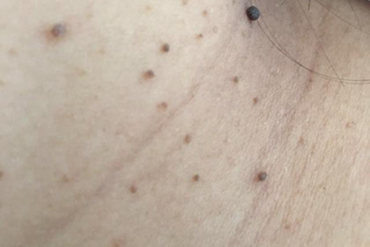 软纤维瘤侧颈症状图 软纤维瘤侧颈症状图