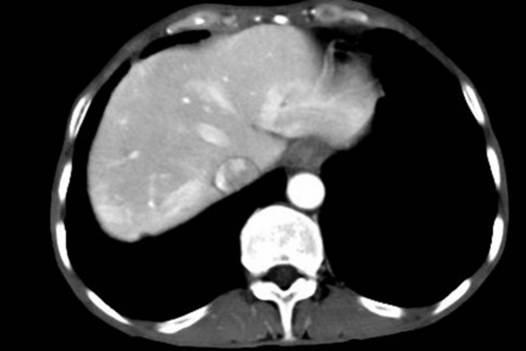 胰腺癌淋巴结转移图 胰腺癌淋巴结转移图