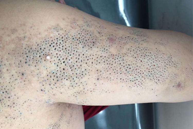 黑头粉刺样痣肩部黑头粉刺图 黑头粉刺样痣肩部黑头粉刺图