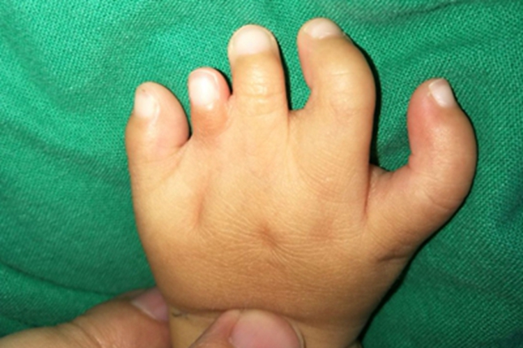 并指畸形手指连在一起图 并指畸形手指连在一起图