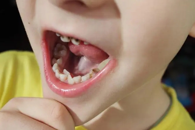 小孩不刷牙牙齿坏掉中龋图