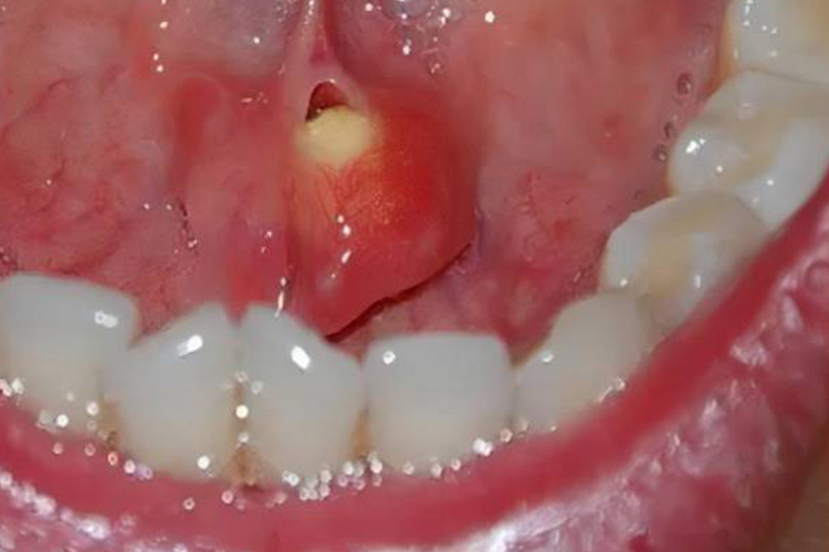 涎石病舌下肉阜肿大图