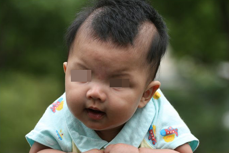 宝宝秃鬓角图