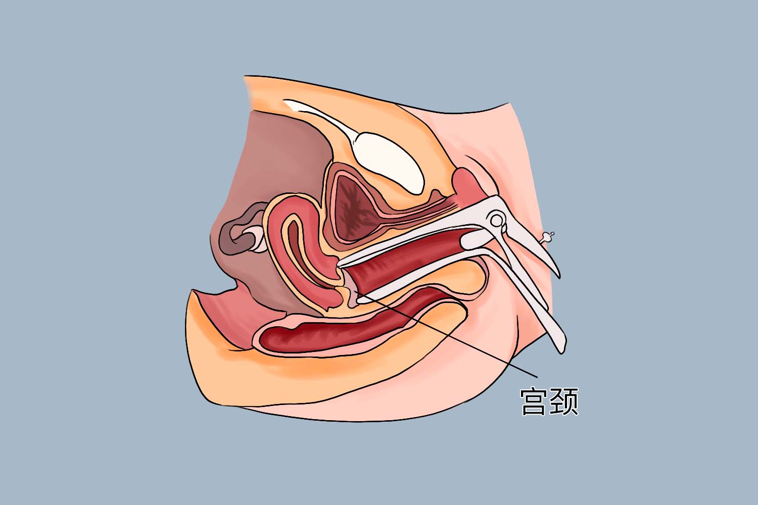 宫颈活检放置阴道窥器图