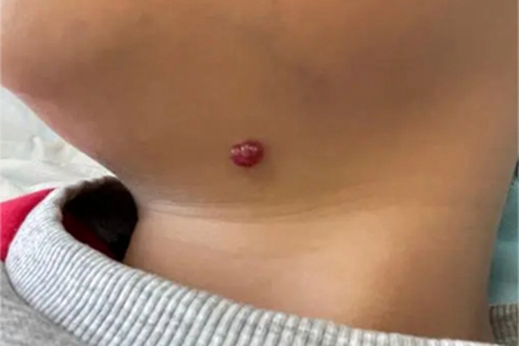 肉芽肿型血管瘤颈部症状图