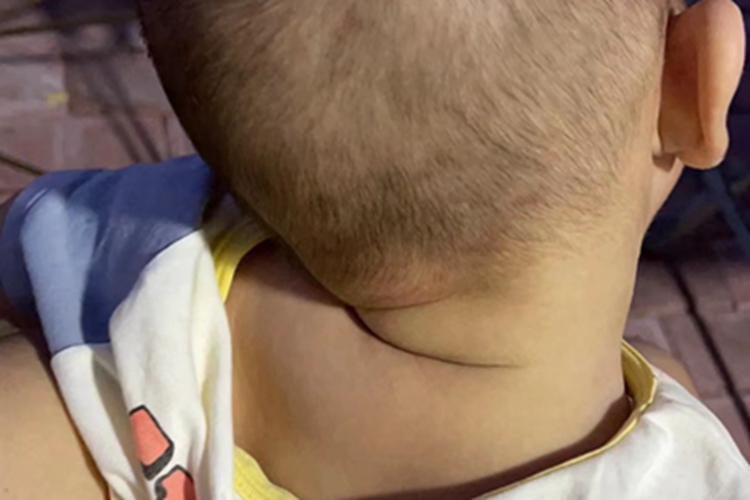 先天性肌性斜颈症状图