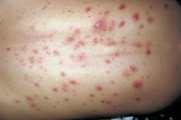 铜绿假单胞菌毛囊炎丘疹图