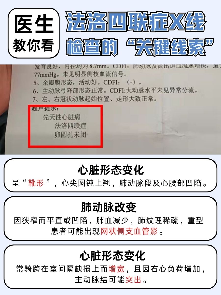 医生教你看：法洛四联症X线的“关键线索”
