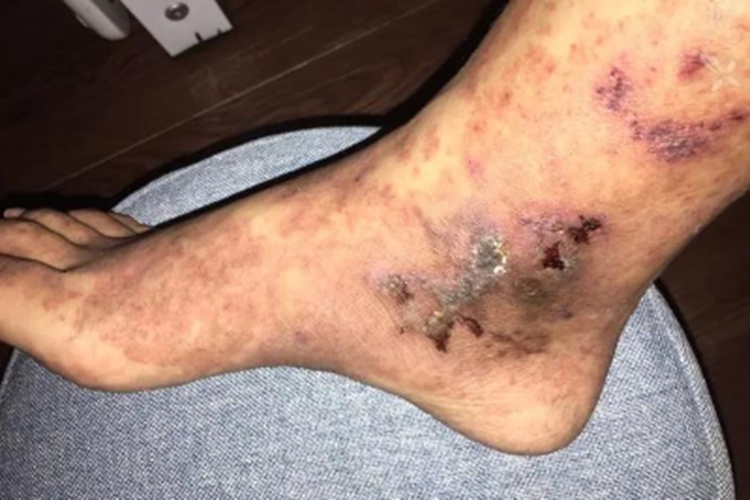 青斑性血管病脚踝症状图