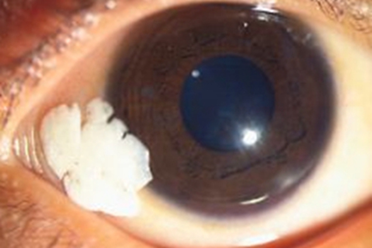 角膜软化症眼角有白色泡沫斑图 角膜软化症眼角有白色泡沫斑图