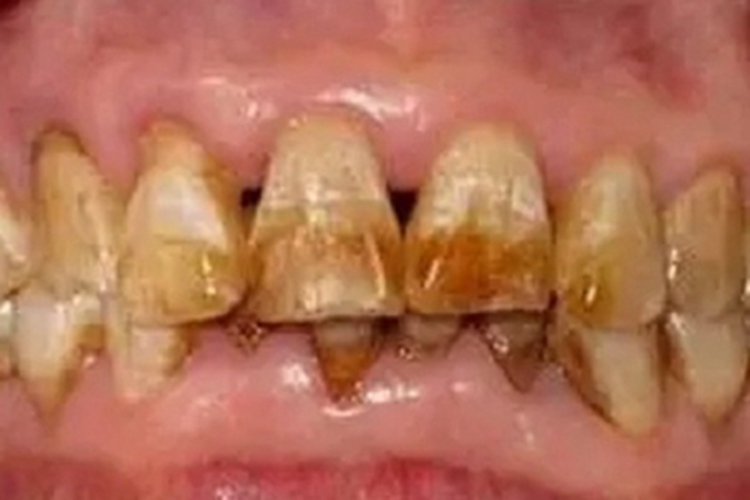 氟牙症门牙褐斑图