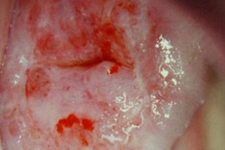 宫颈癌轻度出血渗血图 宫颈癌轻度出血渗血图