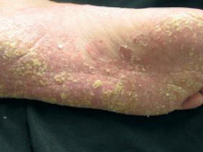 银屑病关节炎脚底长红斑上面都是鳞屑图.jpg