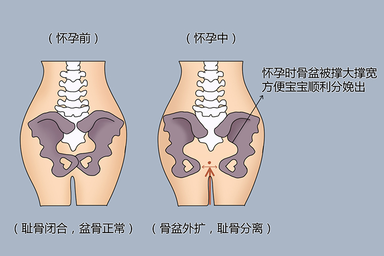 孕妇耻骨联合分离图
