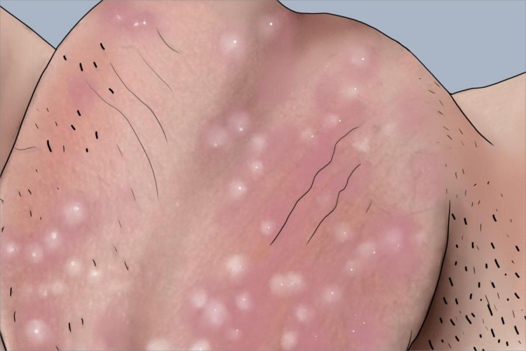 亚急性湿疹阴囊疙瘩手绘图