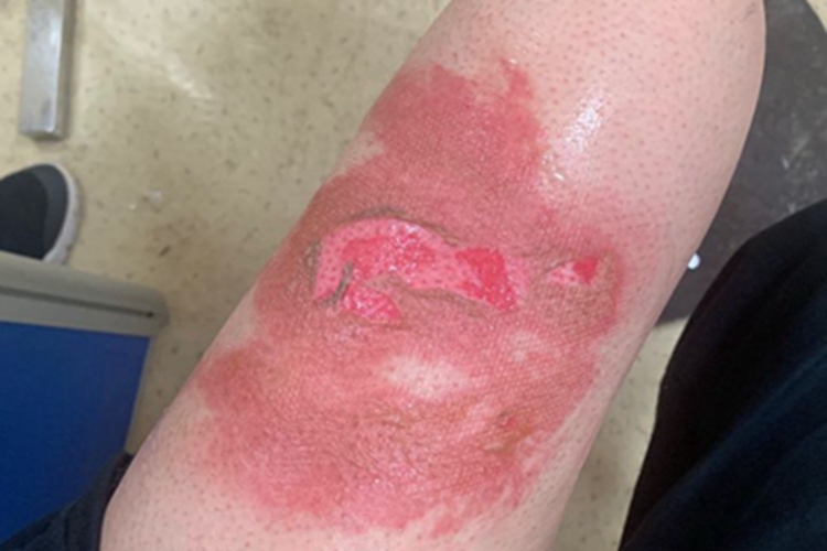 烫伤大腿脱皮图 烫伤大腿脱皮图