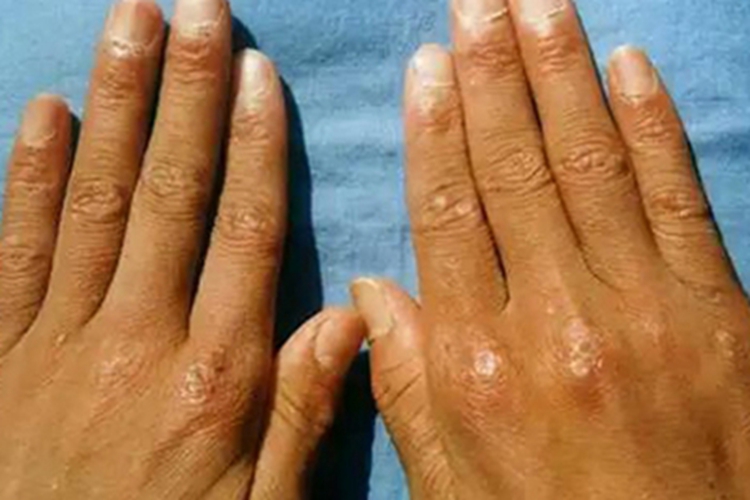 皮肌炎手背症状图