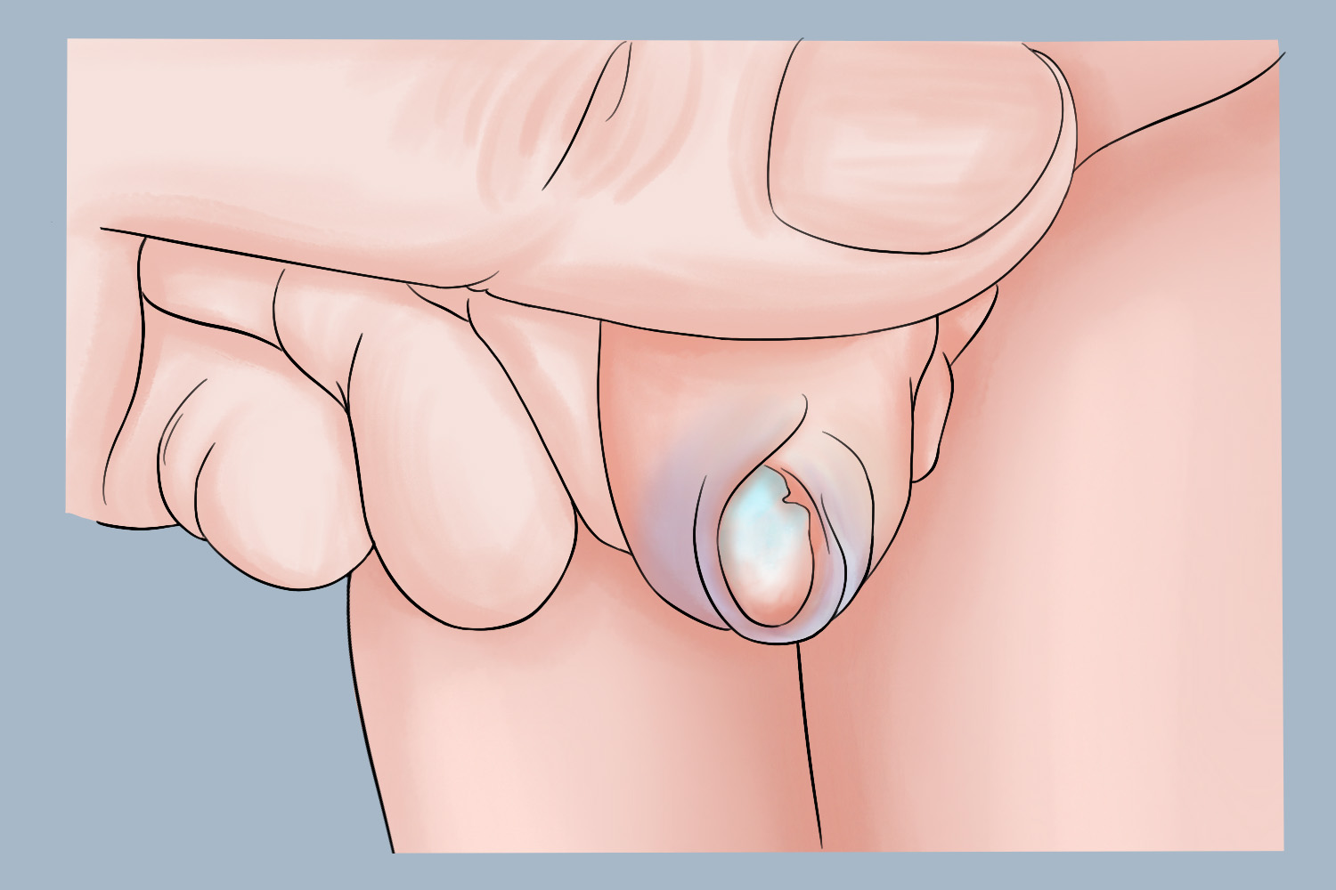 包皮龟头炎包皮渗液手绘图