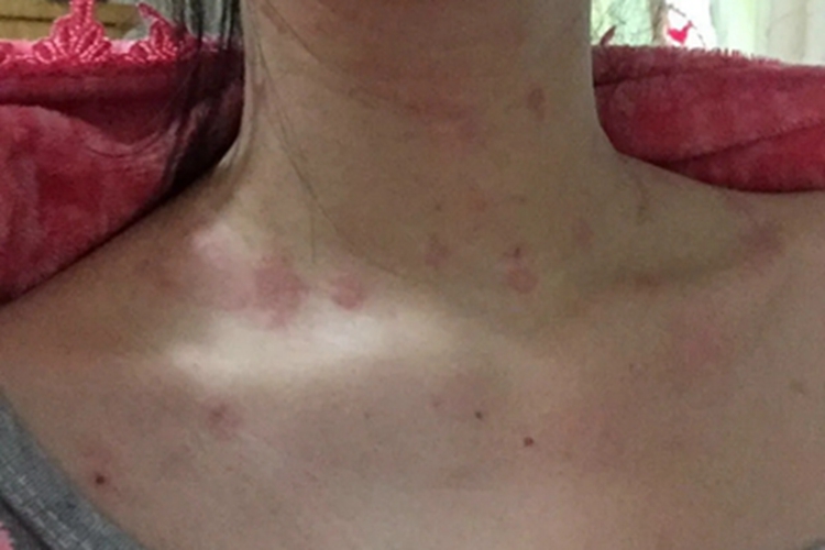 柯萨奇病毒疹颈部风团图