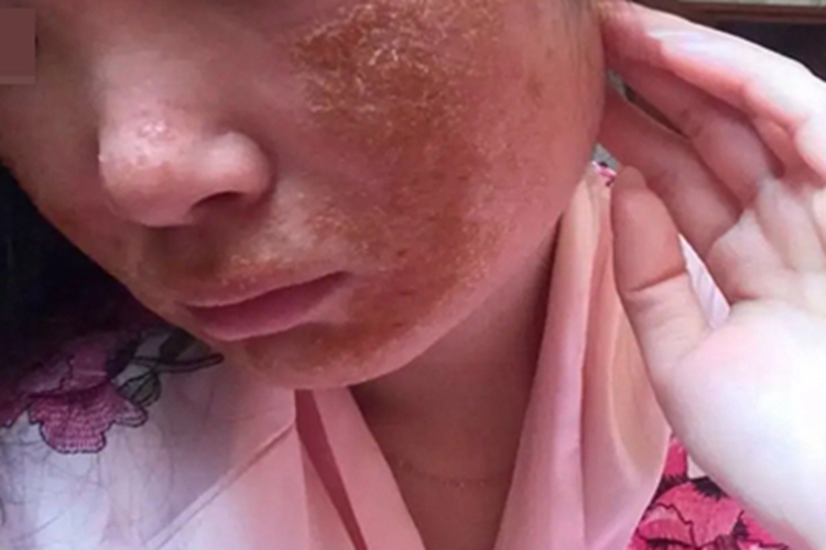 糖皮质激素依赖性皮炎皮肤增厚图 糖皮质激素依赖性皮炎皮肤增厚图