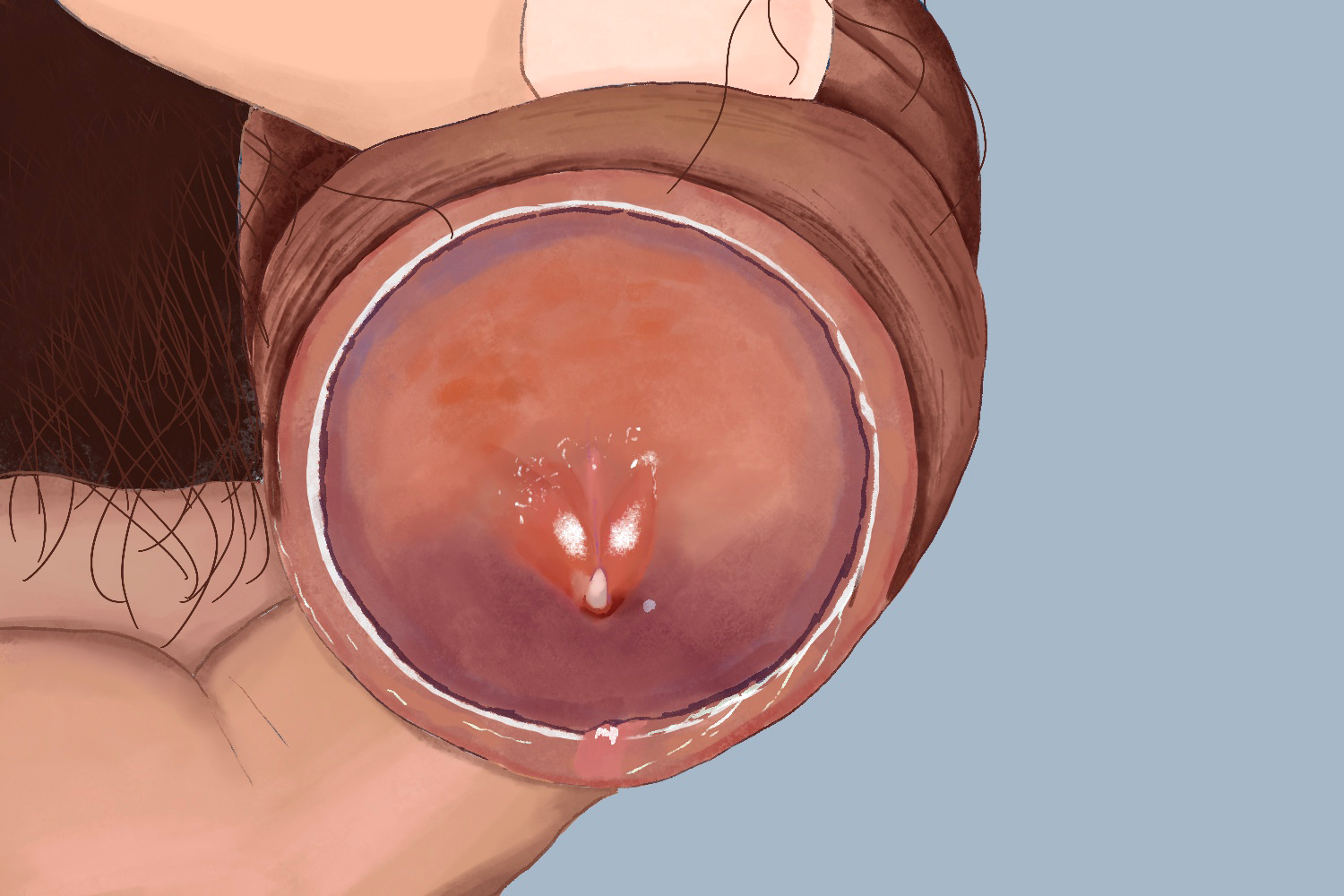 生殖道衣原体感染图