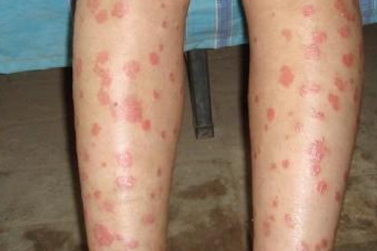 小腿结节性红斑图