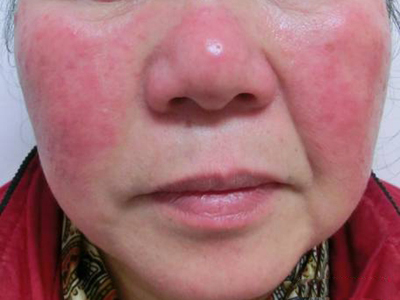 暴发性玫瑰痤疮的症状和图片 - 有来医生