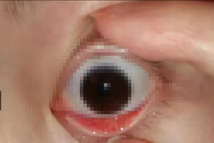 正常眼睑图 正常眼睑图