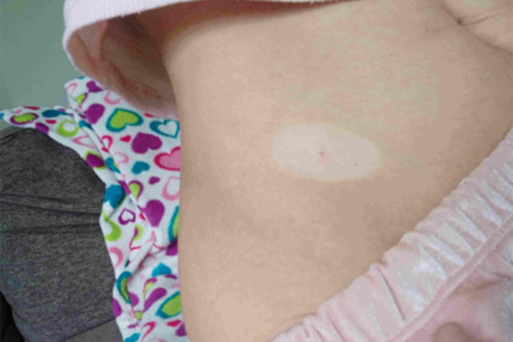 白癜风腹部白点图 白癜风腹部白点图