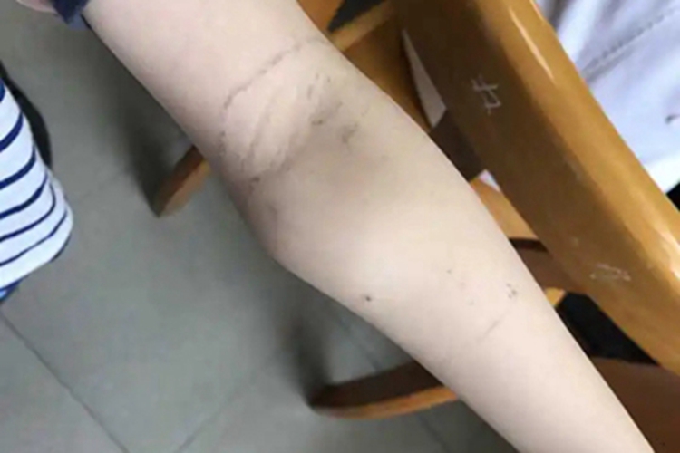 滑膜肉瘤胳膊症状图