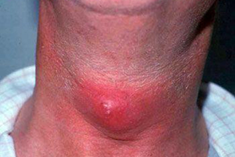 甲状舌管囊肿前颈疙瘩图