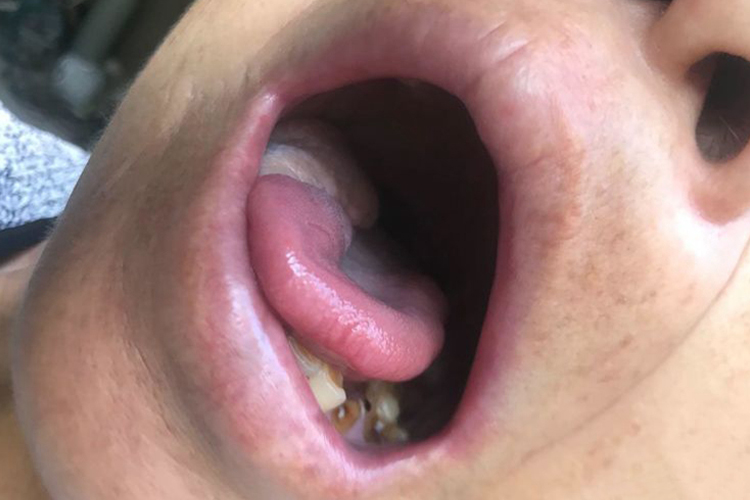 舌癌皮瓣移植成功图