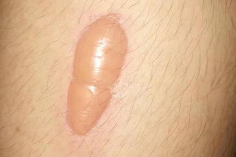 接触性皮炎大腿症状图 接触性皮炎大腿症状图