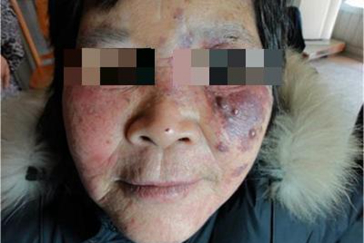 面部变应性接触性皮炎面部红斑图