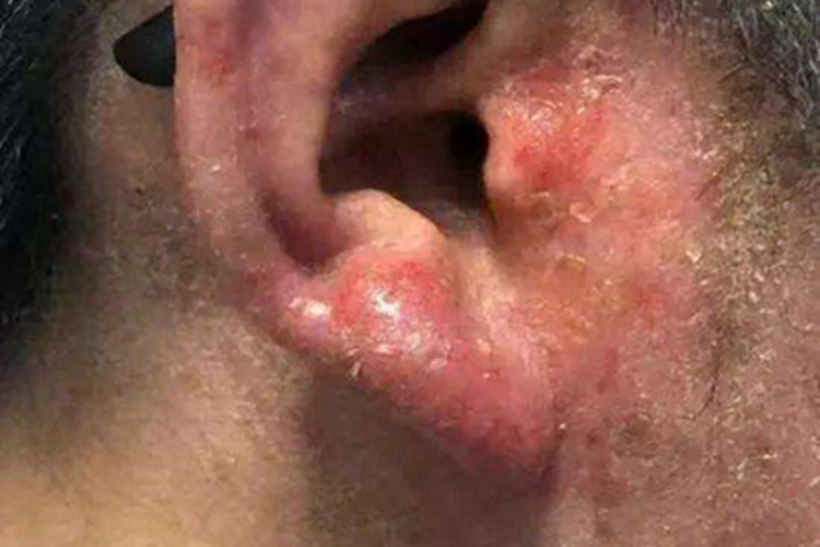 植物光皮炎耳部红肿图