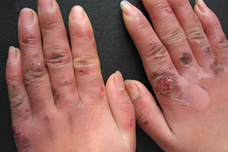 寒冷性多形红斑红肿图 寒冷性多形红斑红肿图