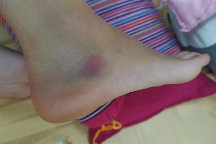 女性左脚脚踝淤青图