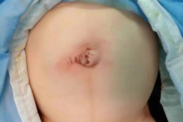 新生儿机械性肠梗阻腹部鼓鼓的图 新生儿机械性肠梗阻腹部鼓鼓的图