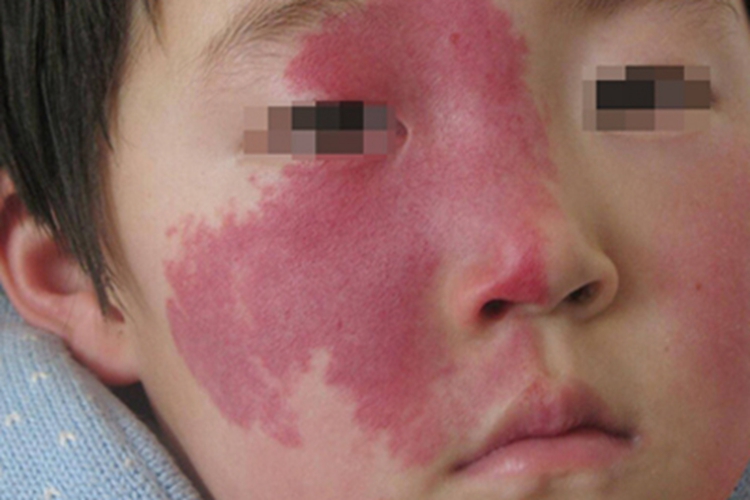 鲜红斑痣小孩脸上长红斑块图