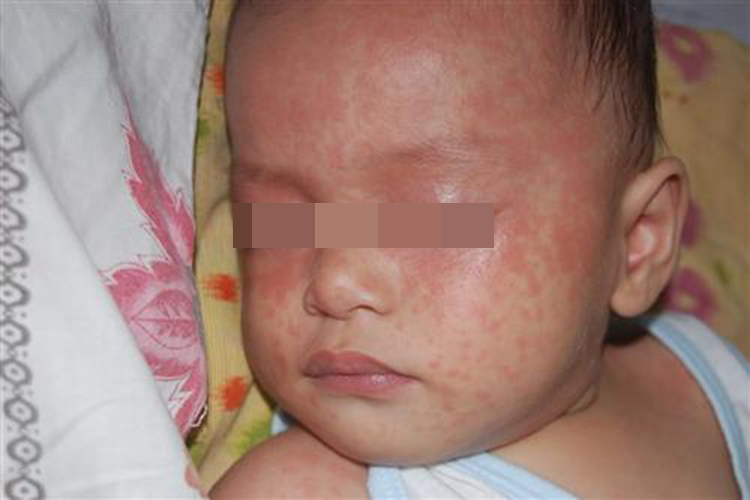 小儿麻疹图 小儿麻疹图