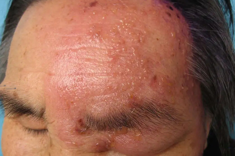 带状疱疹三叉神经第1支分布图