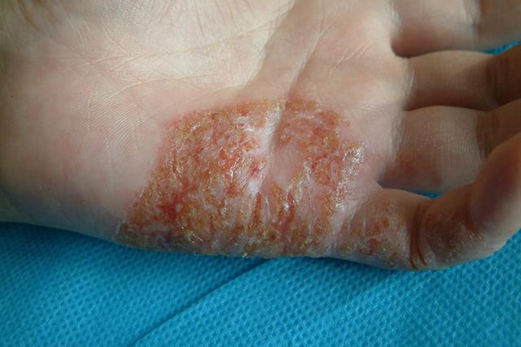 急性期湿疹图