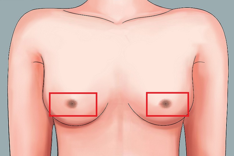乳头皮脂腺囊肿图 乳头皮脂腺囊肿图
