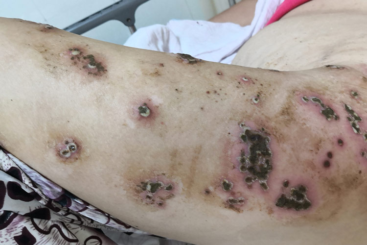 坏疽型带状疱疹图