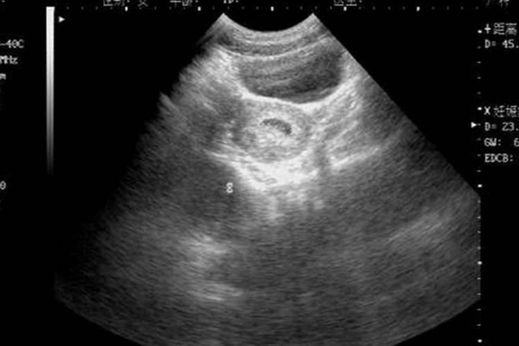 怀孕5周椭圆形妊娠囊B超图 怀孕5周椭圆形妊娠囊B超图