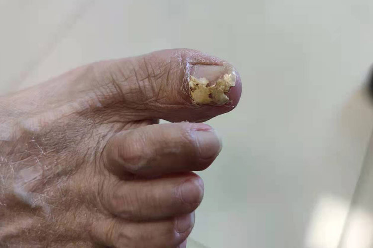 近端甲下型甲癣图