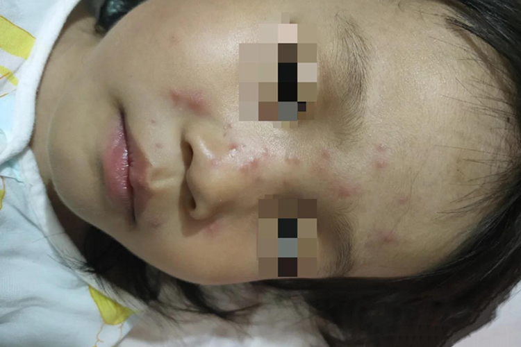 儿童面部毛囊炎图