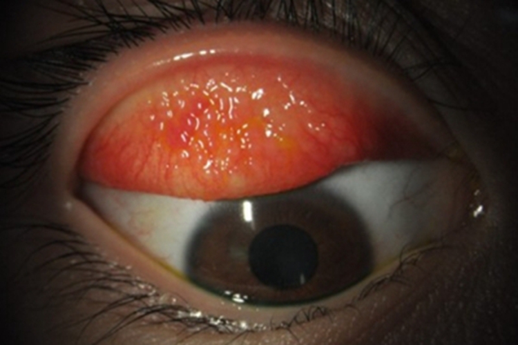 流行性角结膜炎症状图 流行性角结膜炎症状图