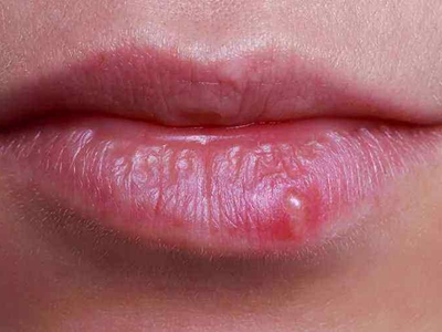 浆细胞性唇炎的症状和图片 