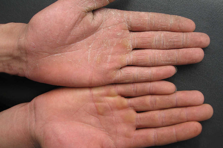 鳞屑角化型手癣呈弥漫性皮肤粗糙,增厚,脱屑,干燥,表现为手指关节有